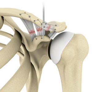 AC Joint Repair