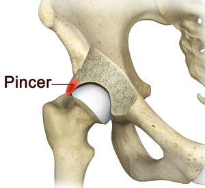 Hip Pincer Resection