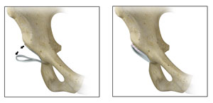 Acetabular Rim Trimming