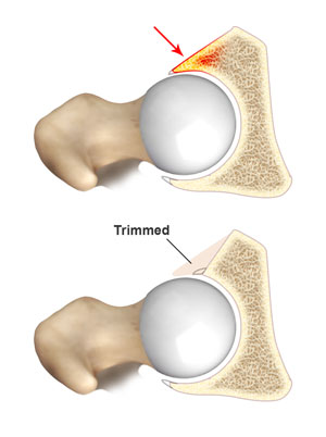 Acetabuloplasty