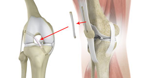 ACL Reconstruction with Quadriceps Tendon