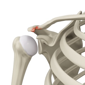 Acromioclavicular (AC) Joint Osteoarthritis