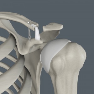 Acromioclavicular (AC) Joint Reconstruction