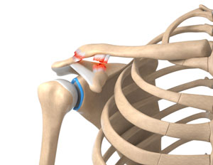 Acromioclavicular Joint Sprains