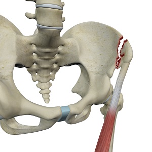 Avulsion fractures of the Pelvis