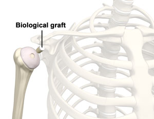 Biologic Shoulder Resurfacing