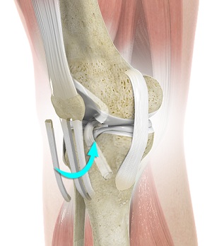 Bone-Patellar Tendon-Bone (BPTB) Allograft