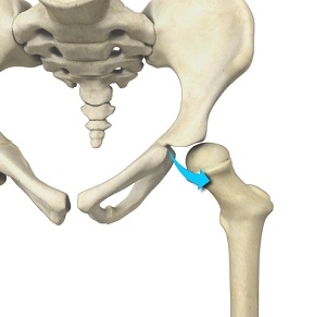 Borderline Hip Dysplasia