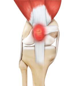 Shoulder Bursitis