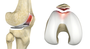 Cartilage Restoration of the Patellofemoral Joint