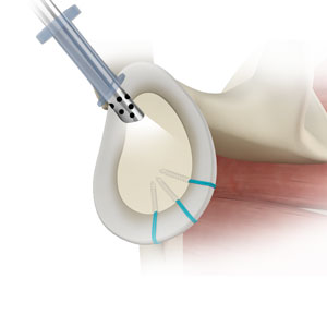 Complex Shoulder Reconstruction