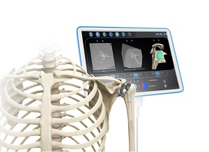 Computer Navigation for Shoulder Replacement