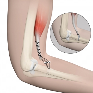 distal-biceps-repair