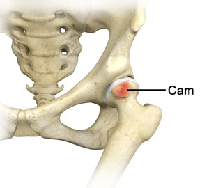 Femoral Osteoplasty