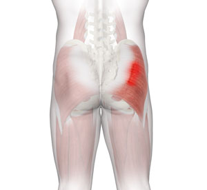 Gluteal Strain