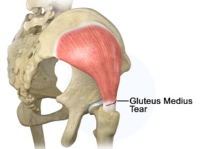 Gluteus Tendon Tear