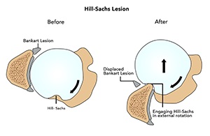 Hill-Sachs Lesion