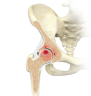 Hip Bone Cysts