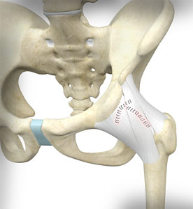 Hip Capsular Closure