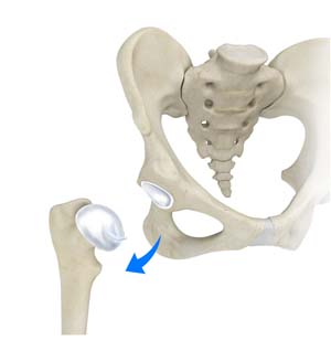 Hip Dislocation?