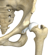 Hip and Groin Disorders<