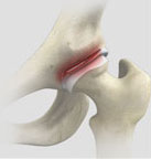 Hip Labral Repair