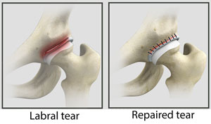 Hip Labral Tear Recovery Without Surgery