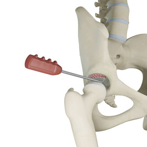 Hip Microfracture