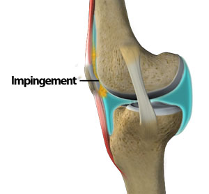 Knee Fat Pad Impingement - Symptoms, Causes and Treatment