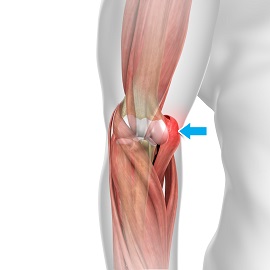 Hyperextension Injury of the Elbow