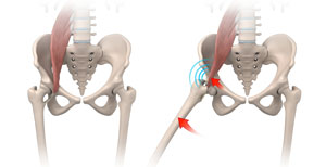 Iliopsoas Impingement