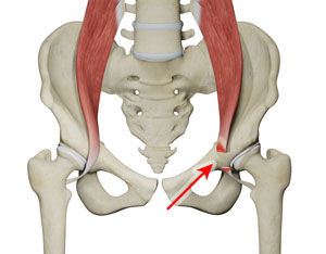 Iliopsoas Tendon Lengthening