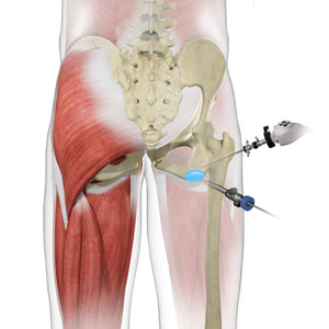 Ischial Bursectomy