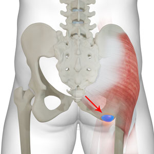 Ischial Bursitis