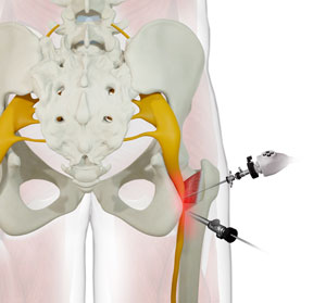 Ischiofemoral Impingement Decompression - Procedure