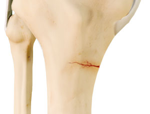 Knee Stress Fractures