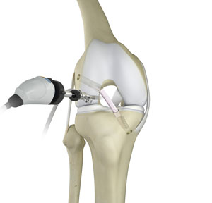 Knee Trauma Reconstruction