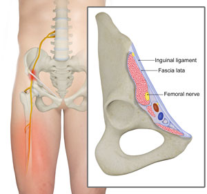 Lateral Femoral Cutaneous Nerve Decompression