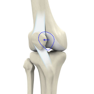 Lateral Patellar Instability