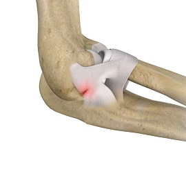 Lateral Ulnar Collateral Ligament Injuries (Elbow) 