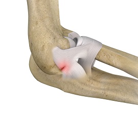 Lateral Ulnar Collateral Ligament Injuries (Elbow)