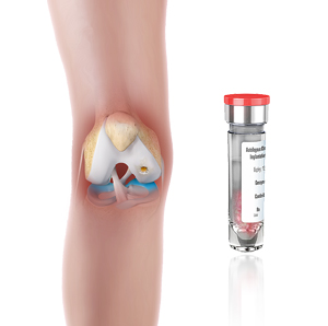 Matrix Induced Autologous Chondrocyte Implantation (MACI)