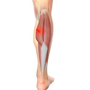 Medial Gastrocnemius Strain