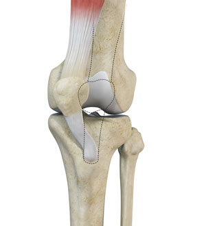 Medial Patellar Instability