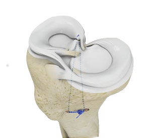 Meniscus Root Repair