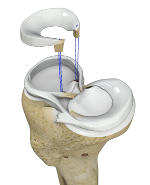 Meniscal Transplantation