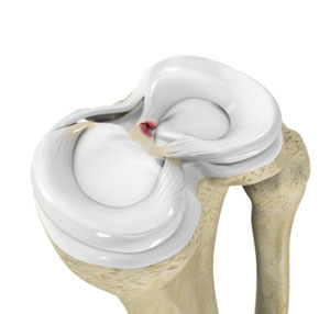 Meniscus Root Tear