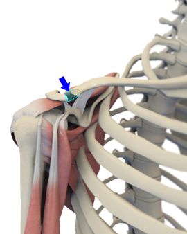 Mumford Distal Clavicle Excision