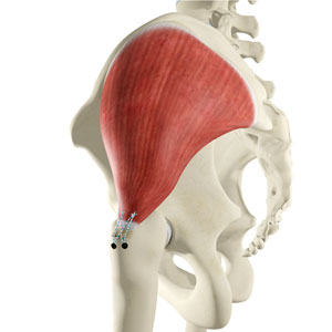 Open Gluteus Medius Repair