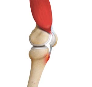 Osgood-Schlatter Disease